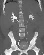 Retrocaval Ureter